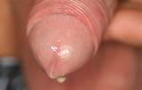 De klap gonorroe infectie Dripping Penile Juice tonen