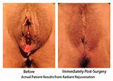 Vaginale verjonging Colpoperineoplasty Seattle