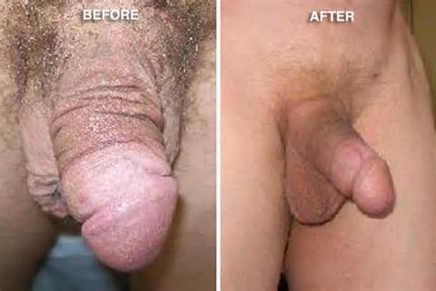 Penile wederopbouw chirurgie Penis reconstructie Procedure