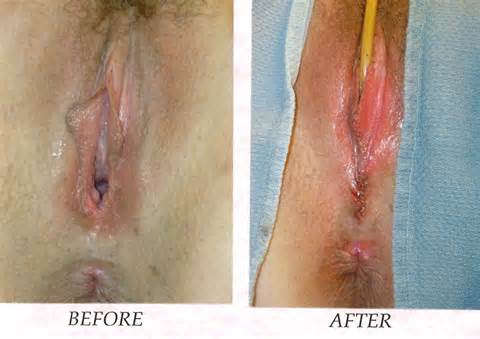 Labiaplasty Arizona vaginale cosmetische chirurgie