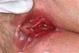 Symptomen van Candida gist infectie RemoveYeastInfection Com