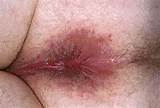 Vagina gist schimmel infectie