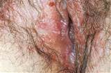 Blauwe wafel vaginale ziekte Image Search Results