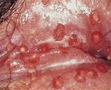 Vrouwelijke Herpes simplexvirus 2 op Pussy