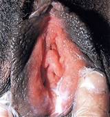 Vrouwelijke gonorroe infectie op Vagina